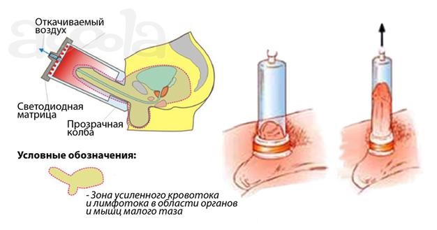 Вакуумный массаж пениса - это ЛОД-терапия